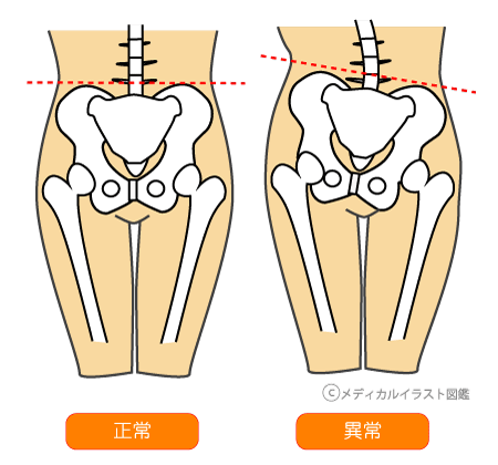 骨盤の歪み